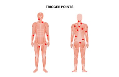 Miyofasyal tetikleyici tıbbi afiş. MTP konsepti. Çizgili kas düğümlerindeki aşırı hassas noktalar erkek siluetinde. İnsan vücudu düz vektör çizimindeki hassas bölgelerde kırmızı noktalar