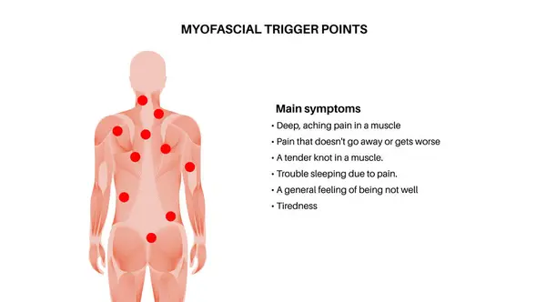 stock vector Myofascial trigger points medical poster. MTrPs concept. Hyperirritable spots in the skeletal muscle knots in male silhouette. Red points in sensitive areas on the human body flat vector illustration