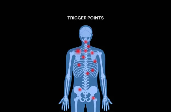 Myofascial Trigger Points Medical Poster Mtrps Concept Hyperirritable Spots Skeletal Vector Graphics