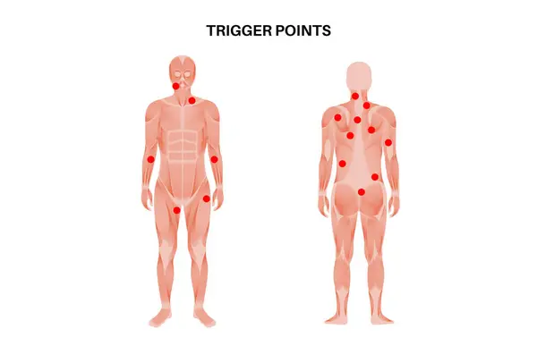 Myofascial Trigger Points Medical Poster Mtrps Concept Hyperirritable Spots Skeletal Royalty Free Stock Illustrations