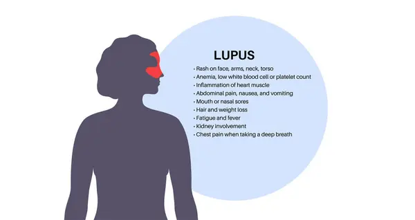 Cartel Médico Sistémico Lupus Eritematoso Erupción Mariposa Malar Cara Femenina Vector De Stock