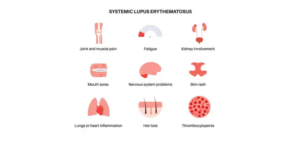Systemischer Lupus Erythematodes Medizinisches Poster Schmetterlings Oder Malarenausschlag Auf Einem lizenzfreie Stockvektoren