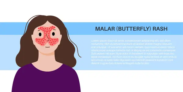 Cartel Médico Sistémico Lupus Eritematoso Erupción Mariposa Malar Cara Femenina Gráficos Vectoriales