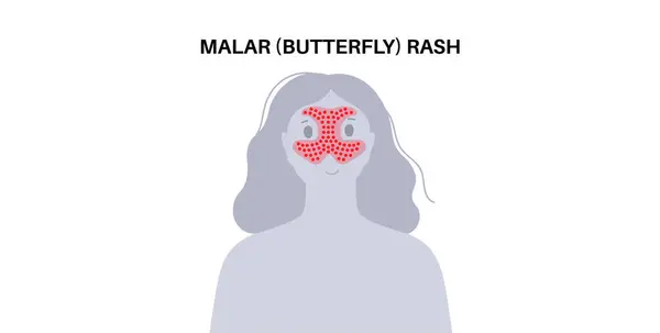 Systemischer Lupus Erythematodes Medizinisches Poster Schmetterlings Oder Malarenausschlag Auf Einem lizenzfreie Stockillustrationen
