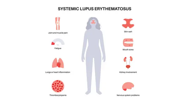 Systemischer Lupus Erythematodes Medizinisches Poster Schmetterlings Oder Malarenausschlag Auf Einem Stockillustration