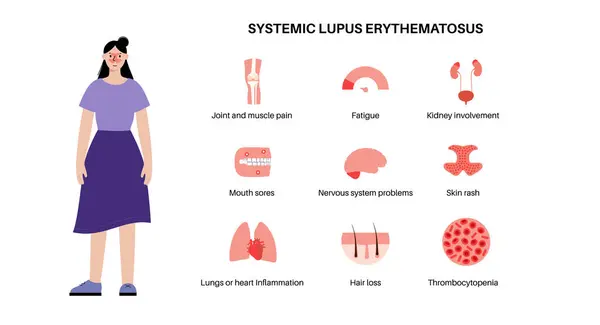 Systemic Lupus Erythematosus Medical Poster Butterfly Malar Rash Female Face Royalty Free Stock Illustrations