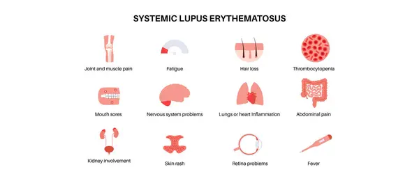 Systemischer Lupus Erythematodes Medizinisches Poster Schmetterlings Oder Malarenausschlag Auf Einem Stockvektor