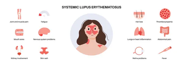 Systemischer Lupus Erythematodes Medizinisches Poster Schmetterlings Oder Malarenausschlag Auf Einem Stockillustration