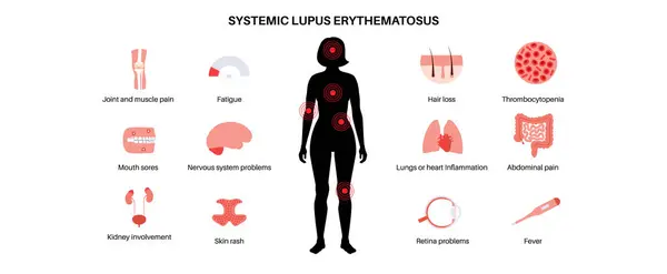 Systemischer Lupus Erythematodes Medizinisches Poster Schmetterlings Oder Malarenausschlag Auf Einem Vektorgrafiken