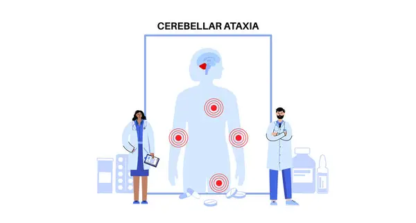 Cartaz Médico Ataxia Cerebelar Doença Degenerativa Sistema Nervoso Discurso Arrastado Ilustração De Stock