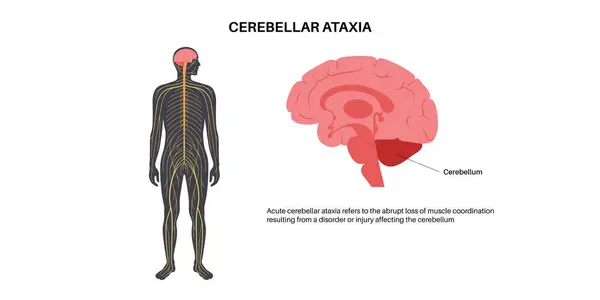 Cerebellar Ataxia Medical Poster Degenerative Disease Nervous System Slurred Speech Royalty Free Stock Illustrations