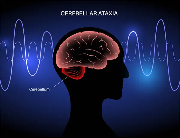 Cerebellar Ataxia Medical Poster Degenerative Disease Nervous System Slurred Speech Stock Illustration