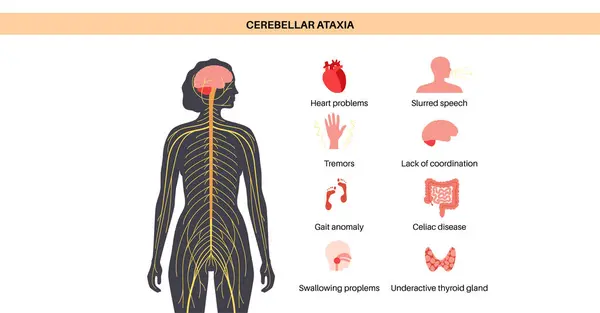 Cartaz Ataxia Cerebelar Doença Degenerativa Sistema Nervoso Principais Sintomas Discurso Vetores De Stock Royalty-Free