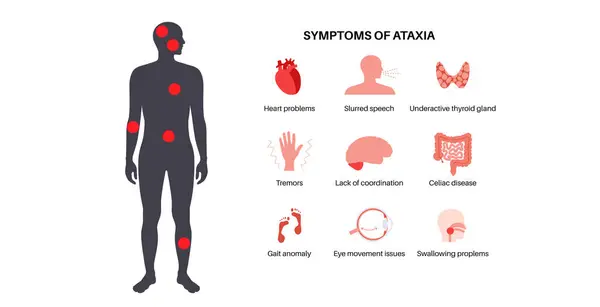 Cartaz Ataxia Cerebelar Doença Degenerativa Sistema Nervoso Principais Sintomas Discurso Ilustrações De Stock Royalty-Free