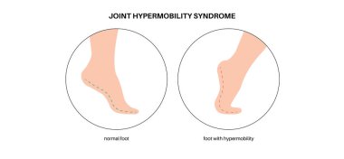 Joint hypermobility syndrome or hypermobility spectrum disorder. Abnormal large range of movement in human legs. Elastic, and stretchy skin and limbs in the human body medical flat vector illustration clipart