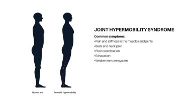 Eklem hareketliliği sendromu ya da hiperhareketlilik spektrumu bozukluğu. İnsan bacağında anormal geniş hareket alanı. İnsan vücudundaki elastik, esnek deri ve uzuvlar tıbbi düz vektör çizimi.