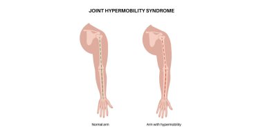 Joint hypermobility syndrome or hypermobility spectrum disorder. Abnormal large range of movement in human arms. Elastic, and stretchy skin and limbs in the human body medical flat vector illustration clipart