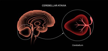 Beyincik ataksisi tıbbi posteri. Sinir sisteminin dejeneratif hastalığı. Konuşma bozukluğu, tökezleme, düşme, koordinasyon eksikliği. Zayıf kas kontrolü, beceriksiz hareketler düz vektör çizimi