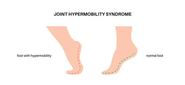 Síndrome Hipermobilidade Articular Distúrbio Espectro Hipermobilidade Grande Variedade Anormal Movimento Ilustração De Stock