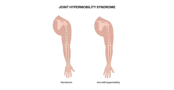 Síndrome Hipermobilidade Articular Distúrbio Espectro Hipermobilidade Grande Variedade Anormal Movimento Vetor De Stock