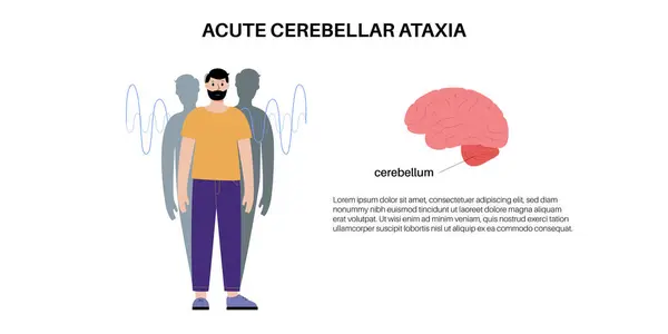 Cartaz Médico Ataxia Cerebelar Doença Degenerativa Sistema Nervoso Discurso Arrastado Gráficos De Vetores