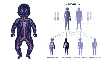 Hemophilia, X linked genetic disease. Inherited bleeding disorder. Blood does not clot properly. Child inherits one copy of a mutated gene from each parent. Affected, carriers or healthy chromosomes clipart