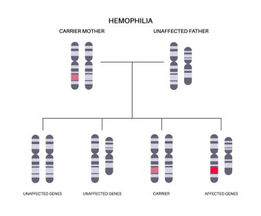Hemophilia, X linked genetic disease. Inherited bleeding disorder. Blood does not clot properly. Child inherits one copy of a mutated gene from each parent. Affected, carriers or healthy chromosomes clipart