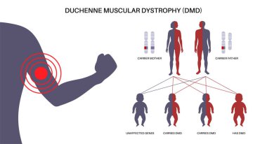 Duchenne kas distrofisi kalıtım kalıbı. Kalıtsal nöromüsküler hastalık. İlerleyen kas dokusu bozulması ve zayıflık. Etkilenmiş, taşıyıcılar veya sağlıklı kromozomlar vektör çizimi.