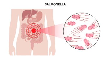 Salmonella bacteria medical poster. Infection in the human body. Infected cells in guts under a microscope. Pain in stomach and intestine. Disease of gastrointestinal tract flat vector illustration clipart