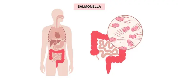 stock vector Salmonella bacteria medical poster. Infection in the human body. Infected cells in guts under a microscope. Pain in stomach and intestine. Disease of gastrointestinal tract flat vector illustration