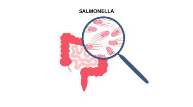 Salmonella bakteri posteri. İnsan vücudunda enfeksiyon. Büyüteç altındaki bağırsaklarda enfekte hücreler. Mide ve bağırsak ağrısı. Mide-bağırsak yolu hastalığı Tıbbi vektör çizimi