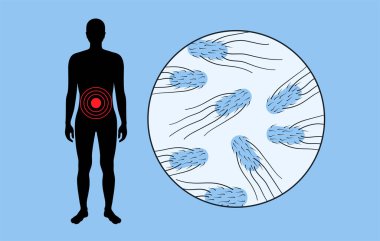 Salmonella bacteria medical poster. Infection in the human body. Infected cells in guts under a microscope. Pain in stomach and intestine. Disease of gastrointestinal tract flat vector illustration clipart