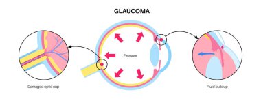 Glaukoma posteri. Artan göz içi basınç, hasarlı optik sinir, görme kaybı. Bulanık görme, görme bozukluğu, ışık ve körlüğün etrafındaki haleler. İnsan gözü hastalığı vektör çizimi.