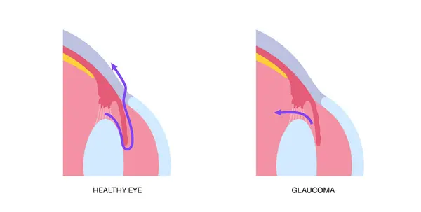 stock vector Glaucoma poster. Increased intraocular pressure, damaged optic nerve, vision loss. Blurry vision, deterioration of eyesight, halos around lights or blindness. Human eye disease vector illustration.