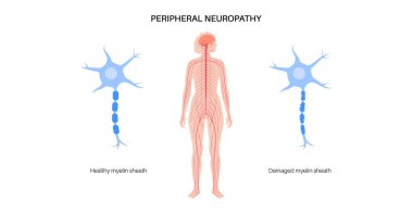 Peripheral neuropathy poster. Hands and feet highlighted areas of pain, numbness, and tingling. Diabetes or injury. Damaged nerves in the nervous system, myelin sheath deformity vector illustration clipart