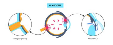 Glaukoma posteri. Artan göz içi basınç, hasarlı optik sinir, görme kaybı. Bulanık görme, görme bozukluğu, ışık ve körlüğün etrafındaki haleler. İnsan gözü hastalığı vektör çizimi.