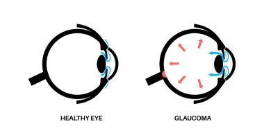 Glaukoma posteri. Artan göz içi basınç, hasarlı optik sinir, görme kaybı. Bulanık görme, görme bozukluğu, ışık ve körlüğün etrafındaki haleler. İnsan gözü hastalığı vektör çizimi.