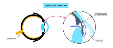 Glaukoma posteri. Artan göz içi basınç, hasarlı optik sinir, görme kaybı. Bulanık görme, görme bozukluğu, ışık ve körlüğün etrafındaki haleler. İnsan gözü hastalığı vektör çizimi.