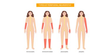 Çevresel nöropati türleri. Mononevriopati, mononevrim multipleks, polinöropati ve pleksopati. Eller ve ayaklar acı, uyuşukluk ve karıncalanma bölgelerini vurguluyor. Hasarlı sinir vektörü çizimi