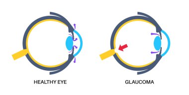Glaukoma posteri. Artan göz içi basınç, hasarlı optik sinir, görme kaybı. Bulanık görme, görme bozukluğu, ışık ve körlüğün etrafındaki haleler. İnsan gözü hastalığı vektör çizimi.