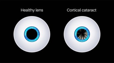 Kortikal katarakt hastalığı, göz ve göz bebeği anatomisi. Mercek bulanıklığı, görme bozukluğu ve potansiyel körlük. Yaşlanırken görme sorunları. İnsan görüşü kaybı konsepti. Körlük 3B vektör illüstrasyonu