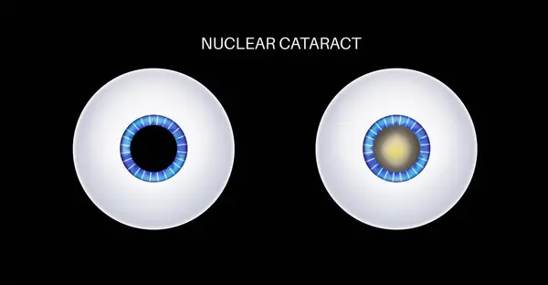 stock vector Nuclear cataract disease, eye and pupil anatomy. Lens clouding, vision impairment, and potential blindness. Vision problems during aging. Human vision loss concept. Blindness 3D vector illustration