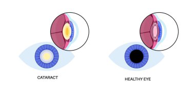 İntraoküler lens yerleştirme posteri. Kataraktlı bir göz ve IOL ile sağlıklı bir göz. Miyopluk ya da hipermetropluk. İnsan görsel sistem anatomisi. Katarakt cerrahi anatomik düz vektör çizimi.