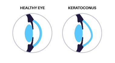 Keratoconus insan gözünün dejenere şekli. Katarakt hastalığı, göz ve göz bebeği anatomisi. Mercek bulanıklığı, görme bozukluğu, körlük. Yaşlanırken görme sorunları. İnsan görme kaybı vektör çizimi