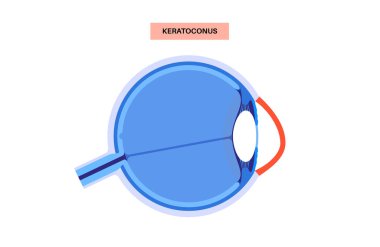 Keratoconus insan gözünün dejenere şekli. Katarakt hastalığı, göz ve göz bebeği anatomisi. Mercek bulanıklığı, görme bozukluğu, körlük. Yaşlanırken görme sorunları. İnsan görme kaybı vektör çizimi