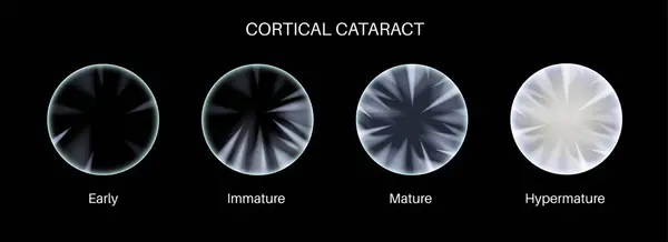 stock vector Cortical cataract disease, eye and pupil anatomy. Lens clouding, vision impairment, and potential blindness. Vision problems during aging. Human vision loss concept. Blindness 3D vector illustration