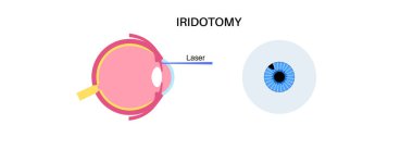 Surgical iridectomy procedure. Intraocular pressure problem. Defect of vision concept. Glaucoma, cataract and melanoma laser treatment. Surgical removal of part human eye flat vector illustration. clipart