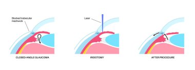 Cerrahi iridektomi prosedürü. İntraoküler basınç sorunu. Görüş bozukluğu konsepti. Glukoma, katarakt ve melanom lazer tedavisi. Kısmen insan gözü düz vektör illüstrasyonunun cerrahi müdahaleyle çıkarılması.