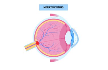 Keratoconus degenerate shape of human eye. Cataract disease, eye and pupil anatomy. Lens clouding, vision impairment, blindness. Vision problems during aging. Human vision loss vector illustration clipart