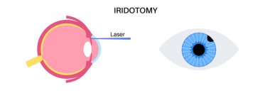 Cerrahi iridektomi prosedürü. İntraoküler basınç sorunu. Görüş bozukluğu konsepti. Glukoma, katarakt ve melanom lazer tedavisi. Kısmen insan gözü düz vektör illüstrasyonunun cerrahi müdahaleyle çıkarılması.
